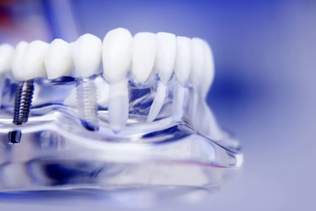 Come sono fatti gli impianti dentali