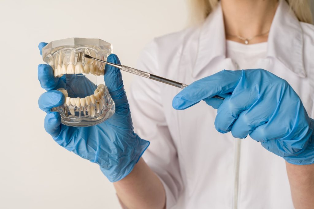 Come sono fatti gli impianti dentali? 1 Implantologia 4