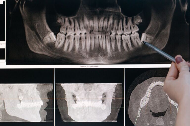 Blog 9 Radiografia panoramica della mandibola con i denti del giudizio
