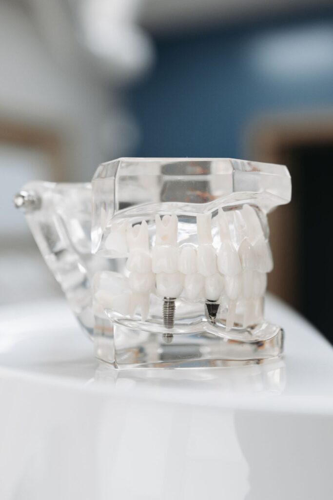 Modello didattico di impianto dentale con vite in titanio