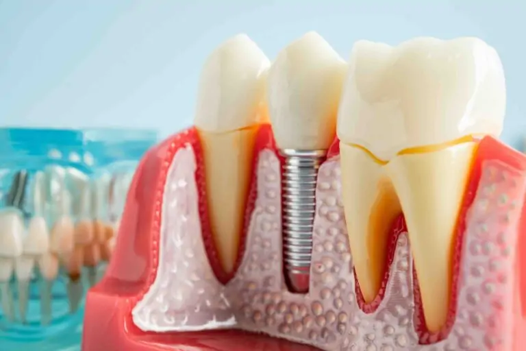 Vantaggi degli impianti dentali